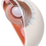 Extrascapular cataract extraction (ECCE)
