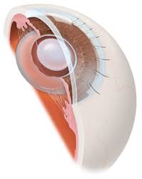 You are currently viewing Extrascapular cataract extraction (ECCE)