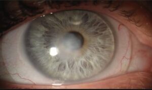 Read more about the article Management of case of Bacterial Keratitis