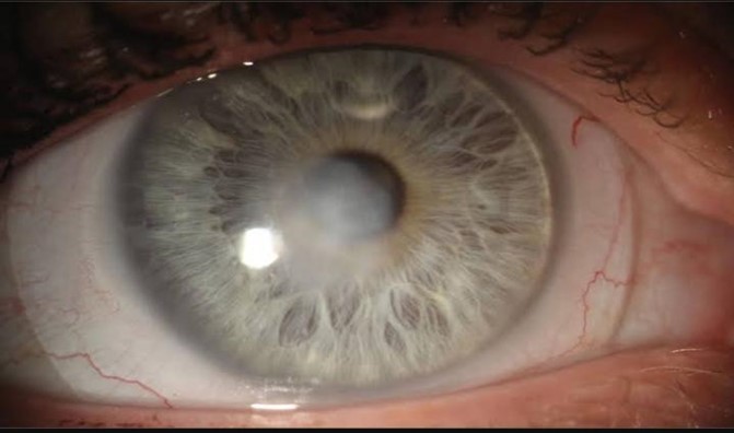 You are currently viewing Management of case of Bacterial Keratitis