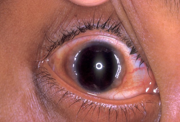 You are currently viewing VERNAL CONJUNCTIVITIS