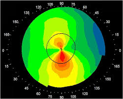 Read more about the article Corneal Topography