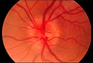 Read more about the article Optic Neuritis