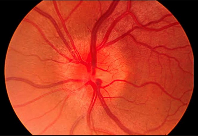 You are currently viewing Optic Neuritis