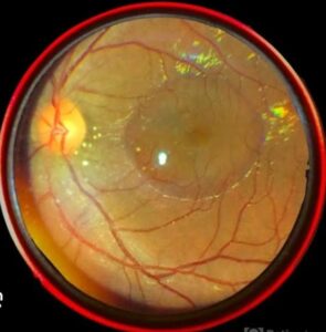 Read more about the article CENTRAL SEROUS CHORIORETINOPATHY