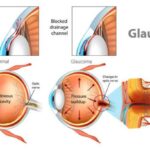Treatment of glaucoma