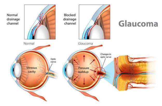You are currently viewing Treatment of glaucoma