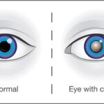 Treatment of modern Cataract Surgery