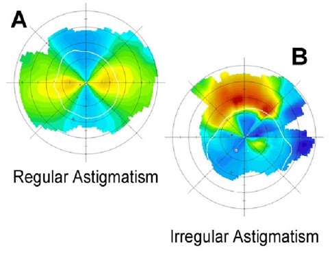 You are currently viewing Regular and Irregular astigmatism