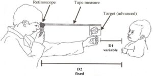 Read more about the article RETINOSCOPY PROCEDURE FOR THE INFANTS