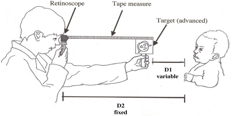 You are currently viewing RETINOSCOPY PROCEDURE FOR THE INFANTS