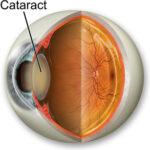 cataract-illustration