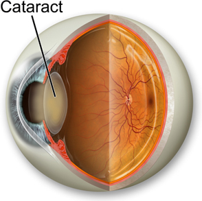 Read more about the article Juvenile Cataract