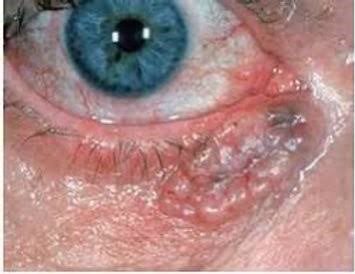 Read more about the article Different Tumors of Eyelids