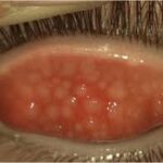 Follicular Conjunctivitis