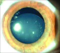 Read more about the article Subluxation Of Crystalline Lens