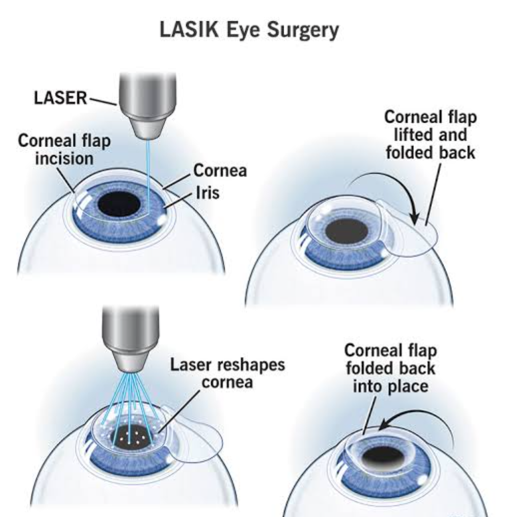 Read more about the article The Pros and Cons of LASIK Surgery