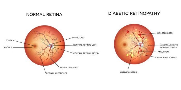 Read more about the article Managing Diabetic Retinopathy