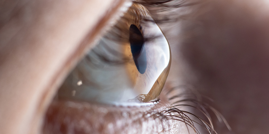 Read more about the article Keratoconus