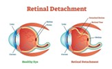 Read more about the article Retinal Detachment