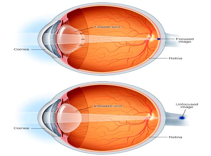 Read more about the article Understanding Presbyopia