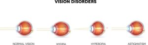 Read more about the article Pathophysiology of Refractive Errors: Understanding Visual Abnormalities