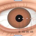 Hirschberg Corneal Reflex Test