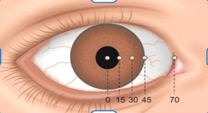 Read more about the article Hirschberg Corneal Reflex Test