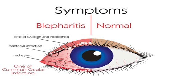 You are currently viewing Common ocular infection and treatment