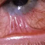 symblepharon