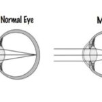 Myopia Control in pediatrics: Evidence Base Options and out come