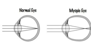 Read more about the article Myopia Control in pediatrics: Evidence Base Options and out come