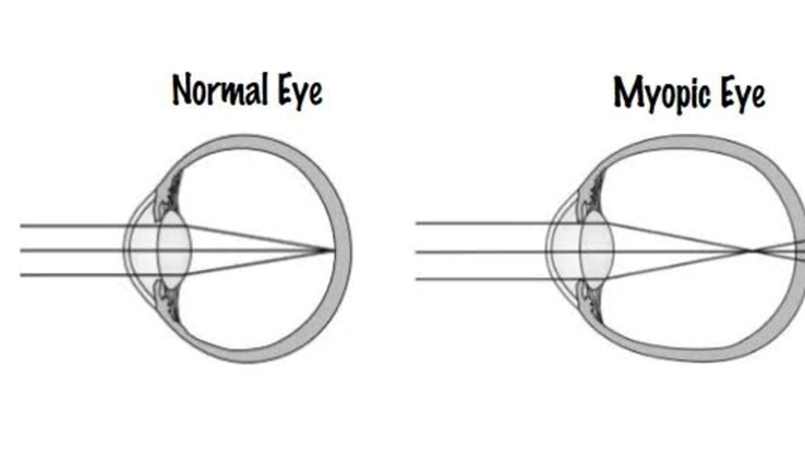You are currently viewing Myopia Control in pediatrics: Evidence Base Options and out come
