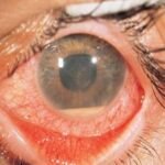 Uveitis management