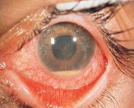 You are currently viewing Uveitis management