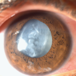 Trauma Turns Cloudy: Understanding  Traumatic Cataracts