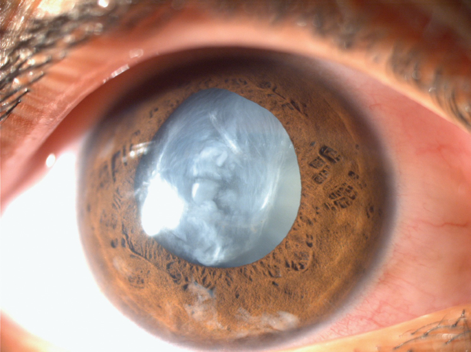 Read more about the article Trauma Turns Cloudy: Understanding  Traumatic Cataracts