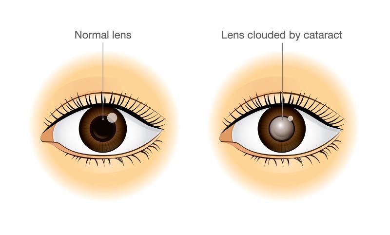 You are currently viewing Importance of cataract awareness