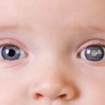 PEDIATRIC CATARACT