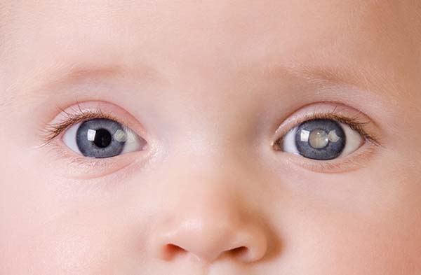 Read more about the article PEDIATRIC CATARACT