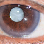 Exeter-Eye-conditions-cataracts-900×368