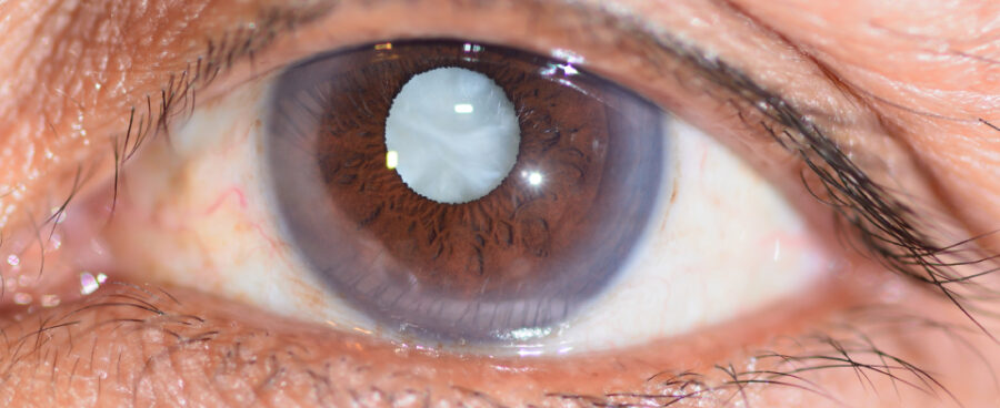 You are currently viewing Cataract causes, symptoms and treatment