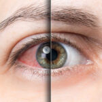 Dry Eye & Contact Lenses: Tips for Comfortable Wear