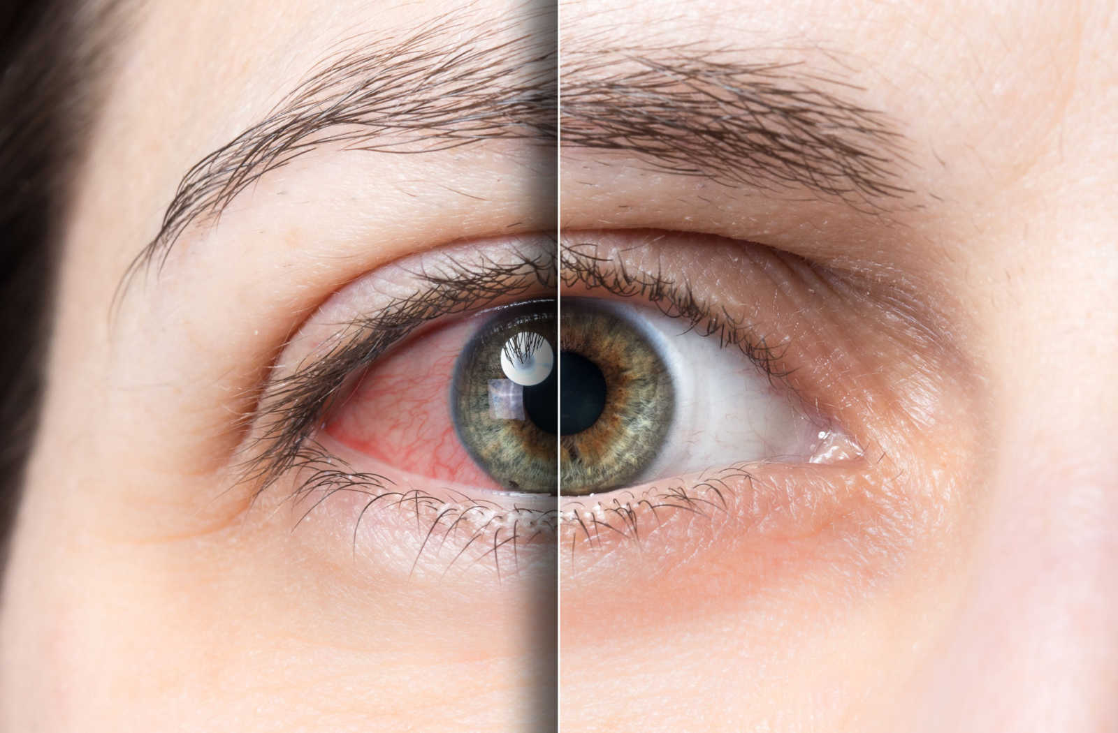 Read more about the article Dry Eye & Contact Lenses: Tips for Comfortable Wear