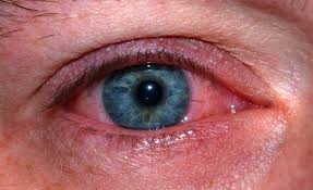 Read more about the article Discuss about Photokeratitis