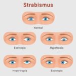 Strabismus in Children: Diagnosis and Treatment