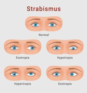 Read more about the article Strabismus in Children: Diagnosis and Treatment