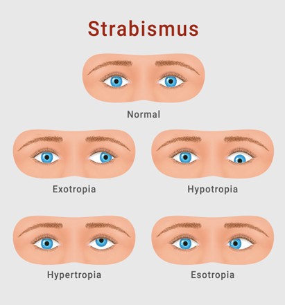 You are currently viewing Strabismus in Children: Diagnosis and Treatment