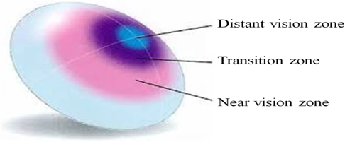 UNDERSTANDING THE ROLE OF CONTACT LENSES IN MYOPIA CONTROL - Optography