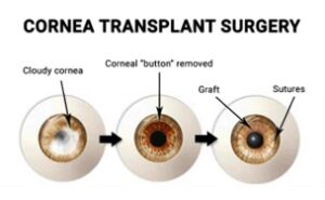 Read more about the article Corneal Donation: The Ultimate Gift of Sight After Life